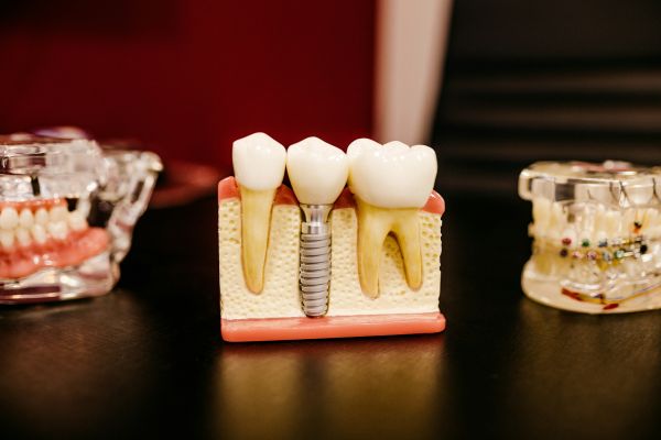 Implant dentaire : à quoi s'attendre le jour de la pose